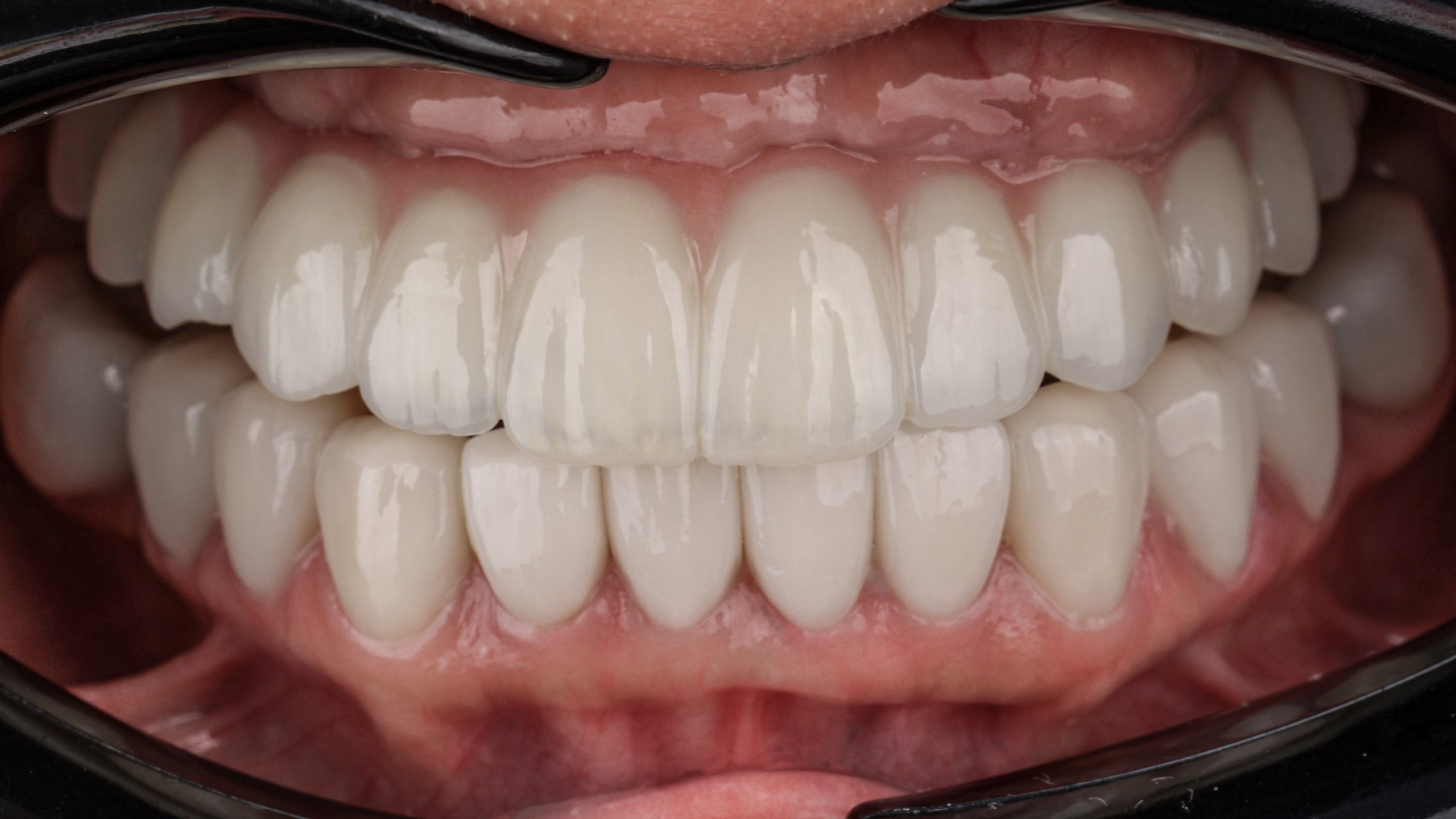After-implantdenture